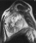 f31.mediumneyrofibroma.gif