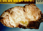 f36.mediumdesmoid_tumor.gif