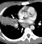 f4.mediumpervichnyy_tuberkulez.gif