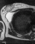 f43.mediumrabdomiosarkoma.gif