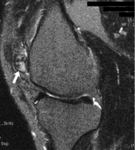 f47.mediumsinovialnaya_sarkoma.gif