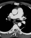 f48.mediumkost_sarkoidoza.gif