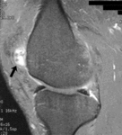 f48.mediumsinovialnaya_sarkoma.gif