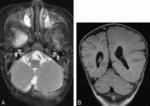 f6.mediumhemimegalencephaly.gif