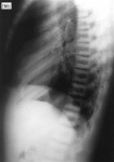 1.spine-t_osteopetrosis_lat.jpg