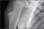 risunok1_osteohondroma.jpg