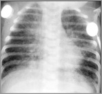 080_chlamydial_pneumonia.jpg