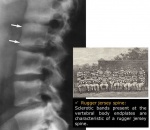 1.picture1osteopetrosis.jpg