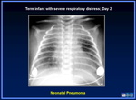 106_term_infant_day_2_pneumonia.jpg