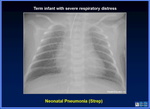 113._term_infant_with_severe_respiratory_distress_pneumonis.jpg