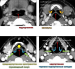 2015-09-04_20-59-58_radiografiya-2015._minsk._prezentaciya._kt-diagnostika_raka_shei_-_pdf.pdf_str._70_iz_110.png