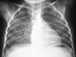 active-tuberculosis_2.jpg