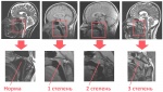 adenoidy-stepeni-uvelicheniya_11.jpg