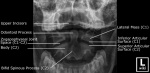 cervical-spine-odontoid.jpg