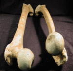 excessive-femoral-anteversion-in-adults-776.gif