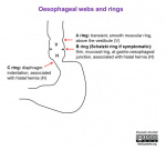 oesophageal_webs_and_rings_gallery.jpeg