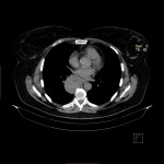 paraganglioma_predpolagaemaya.jpg