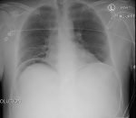 perforated-ulcer-ap-cxr.-jetem-2016.jpg