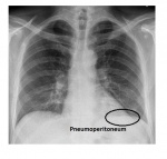 pneumoperitoneum.jpg