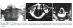 transverse_ligament_injures_rus.jpg