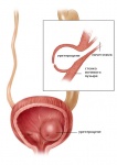 ureterocele-2.jpg