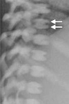 0.115093fig02bosteopetrosis.jpeg