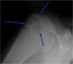 0.chondroblastoma13.jpg