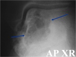 0.chondroblastoma32.jpg