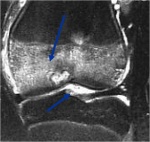 0.chondroblastoma39b.jpg