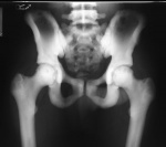 0.osteopetrosis4.jpg