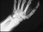 1.wrist_osteopoykilosis.jpg