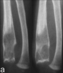 11_mo_f_-_ulna_after_15_mo_onset.jpg