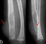 11_mo_f_-_ulna_after_8_mo_follow_up.jpg