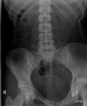 4.osteopoikilosis_kub.jpg