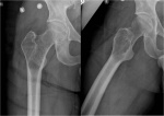 8.osteoblastomaproximalfemur1.jpg
