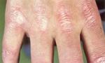 gottrons_patches_on_the_knuckles_in_dermatomyositis..jpg