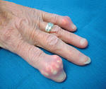 gout_with_tophus_formation_in_the_index_and_little_fingers1.jpg