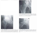 osteoarhtritis-3.jpg