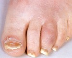 sausage_toes_with_associated_nail_dystrophy..jpg