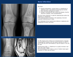 Инфаркт костного мозга костей. Обызвествление костного мозга в бедренной кости на кт. Инфаркт костного мозга коленного сустава рентген. Обызвествление костного мозга рентген. Инфаркт кости коленного сустава рентген.