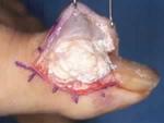surgical_removal_of_the_the_uric_acid_deposit_in_gout..jpg