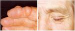 tophi_on_the_finger_left_and_eyelid_right_in_tophaceous_gout._.jpg