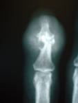 x-ray_of_finger_with_longstanding_gout._erosions_are_present_in_the_bone_at_the_end_joint_as_well_as_swelling_of_the_soft_tissue.jpg