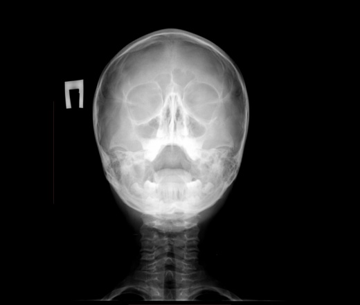 Рентгенография придаточных пазух носа в двух проекциях | Медцентр Авиценна