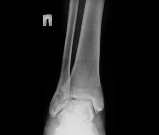 Артрит голеностопного сустава на рентгене