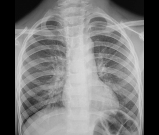 Что означает в заключении рентгенолога: корни легких расширены