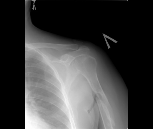 Несросшийся перелом плечевой кости
