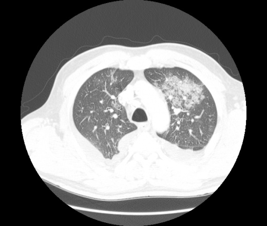Мягкотканное образование в легком на кт