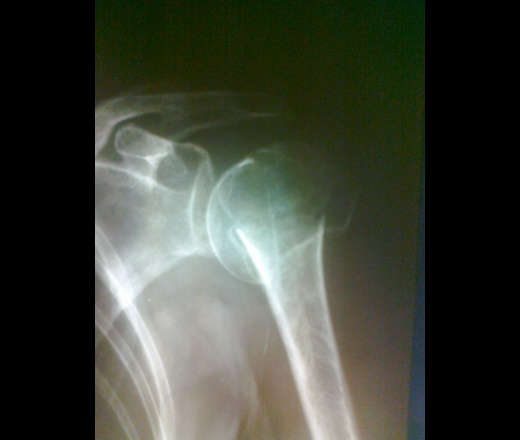 Рентген перелома плечевой кости