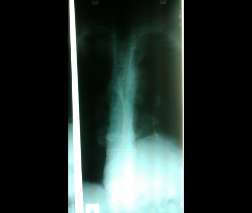 Кифоз грудного отдела позвоночника рентген